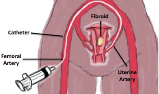 Unveiling Top-notch Uterine Fibroid Treatment in Delhi: Expert Care and Affordable Solutions