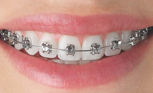 Exploring Orthodontic Treatment in the UK: Enhancing Oral Health and Aesthetics