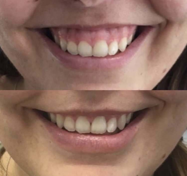 Transformation Ihres Lächelns: Effektive Techniken zur Korrektur eines gummy smile