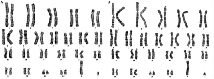 Karyotype Analysis for Rare Disease