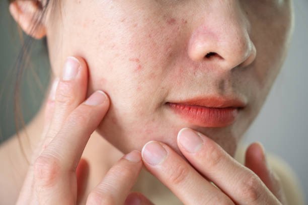 How to Determine if You Have Acne-Prone Skin?
