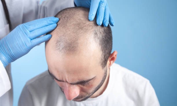 Hair Transplant Surgery Demystified: What Riyadh Residents Need to Know