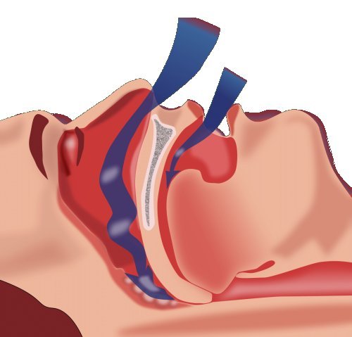 The most effective home remedies for sleep apnea 
