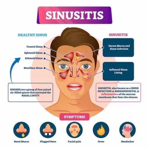 Homeopathic Treatment for  Sinusitis and Post-Nasal Drip