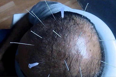 Acupuncture for Hair Loss