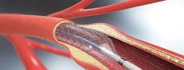 Vascular Grafts Market Size, Trends, Share, Growth 2024-2032