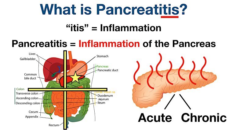  Pancreatitis: Causes, Symptoms, and Homeopathic Treatment 