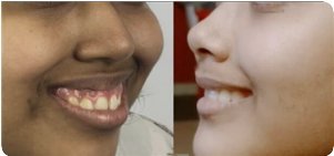 Affordable Gummy Smile Correction Cost in India | Edens Dental