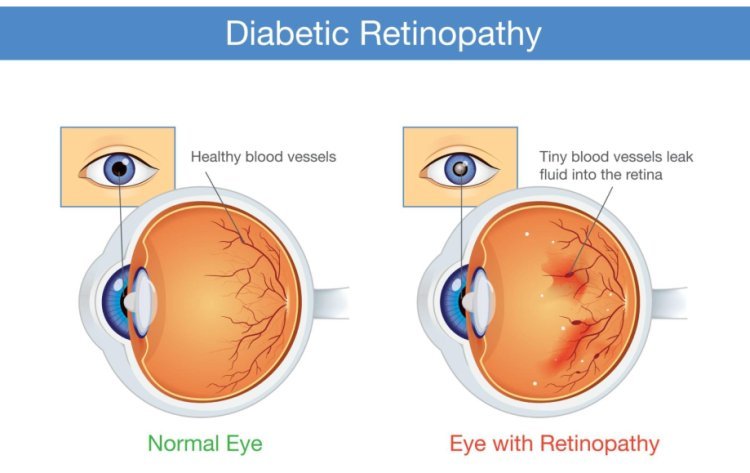 Diabetic Retinopathy Treatment In Dubai