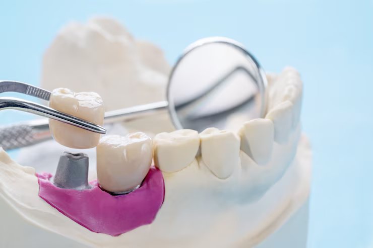 Dental Implants - Replacing a Single Tooth Or Multiple Teeth