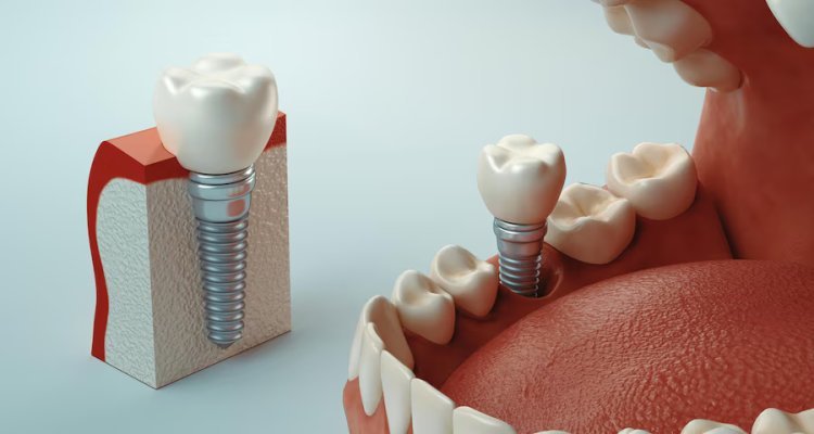 Dental Implants in Huntsville, AL: The Ultimate Solution for Tooth Replacement