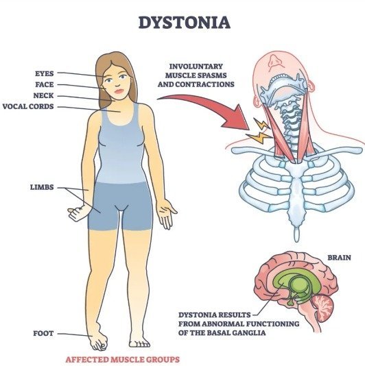 Dystonia Disease: Symptoms & Care 