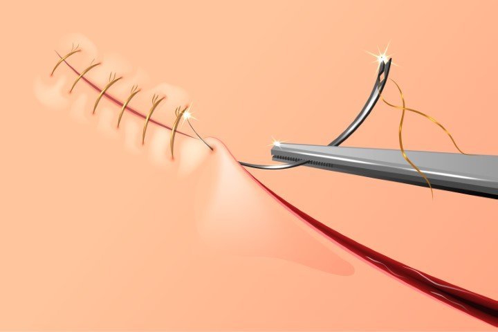 Japan Surgical Sutures Market Latest Trends, Size, Industry Overview, Forecast 2024-2032