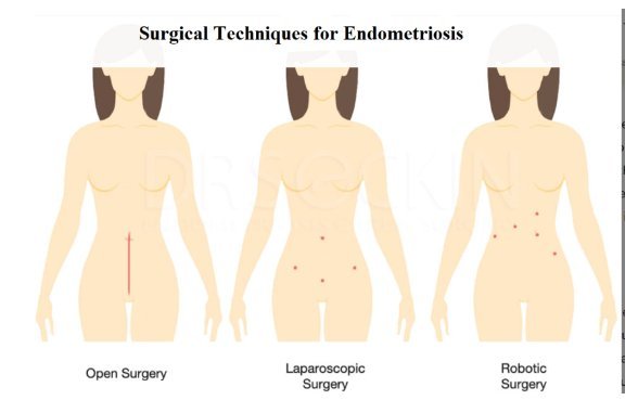 Natural Treatment for Endometriosis  