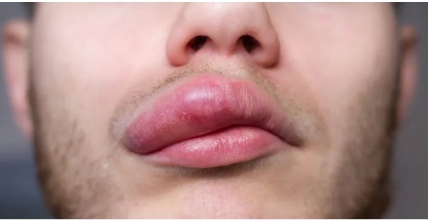 Angioedema: Causes, Symptoms, and Treatment Options  
