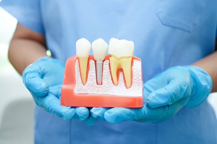 Your Ultimate Guide to Dental Implants in Dallas