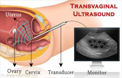 Comprehensive Guide to Transvaginal Scan in Lahore: LincsHealth