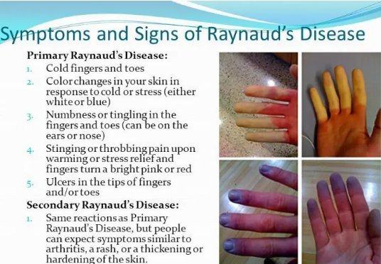 Acupuncture and Homeopathy for Raynaud’s Syndrome: A Comprehensive Overview  