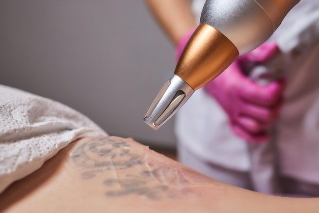 How Effective is PicoSure Tattoo Removal for Different Ink Colors in Dubai?