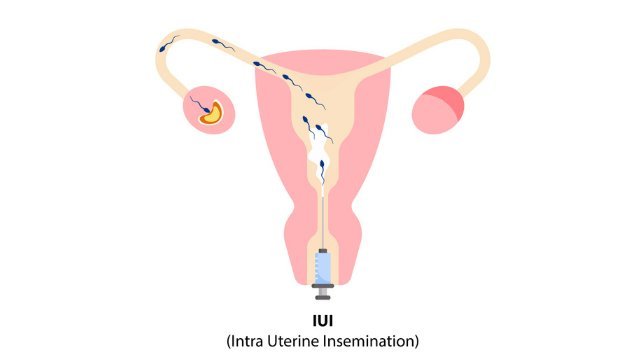 IUI Treatment in Lahore AustralianConcept Infertility Center