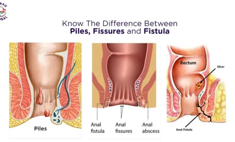 Know The Difference Between Piles, Fissures and Fistula