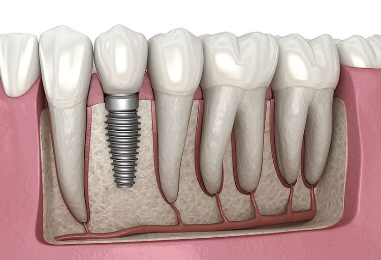 Transform Your Smile with Dental Implants and Bridges in Bakersfield by San Dimas Dental Care