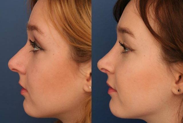 Reshape, Refine, Revitalize: Rhinoplasty in Riyadh