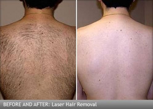 Fast & Effective: Laser Hair Removal Treatments in Dubai