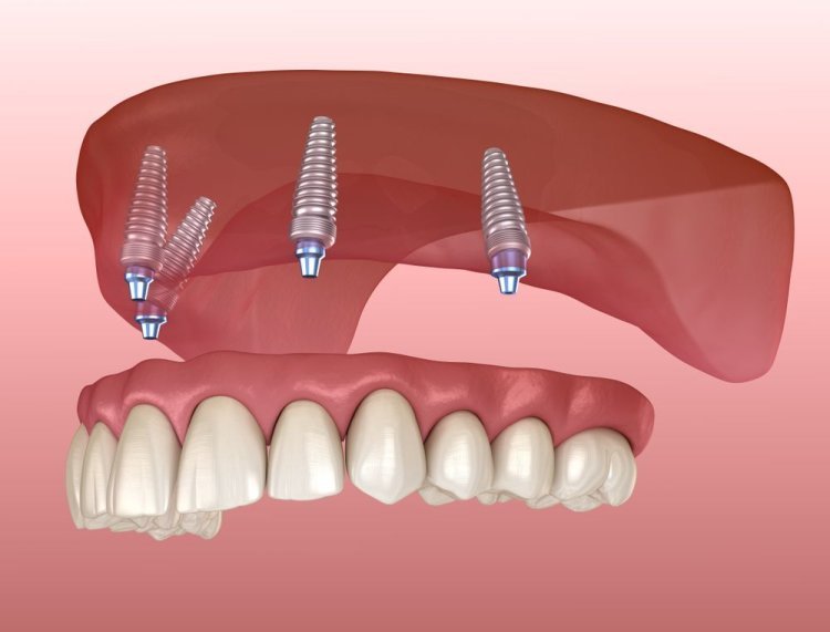 What Are the Benefits of All-on-X Implants Over Traditional Dentures?