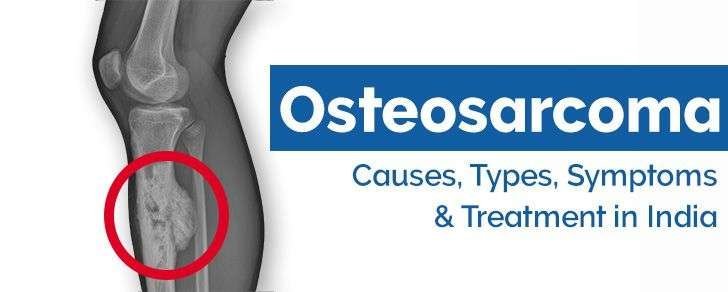 Top Considerations Before Getting Osteosarcoma Surgery in India.