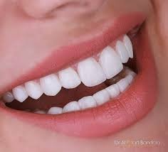 Veneers Dubai – Are They Really the Best Choice for a Perfect Smile?