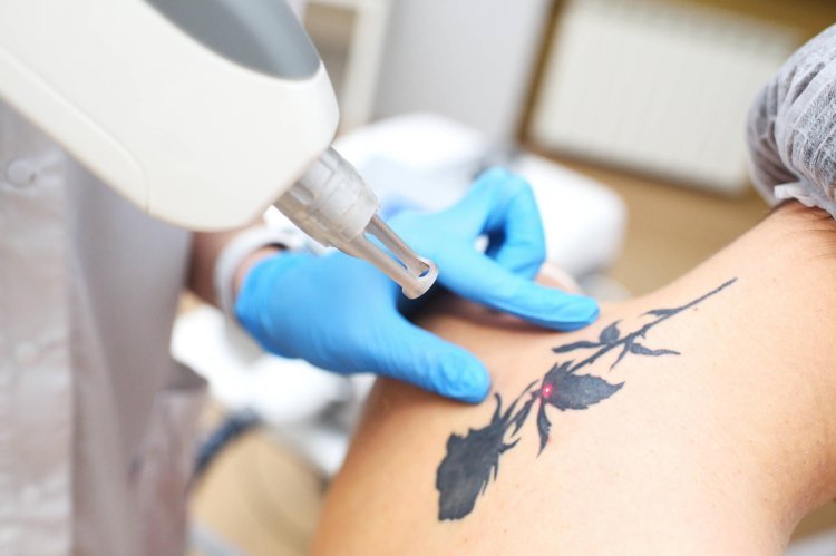 Safe & Effective Tattoo Removal Methods in Islamabad: A Comprehensive Guide