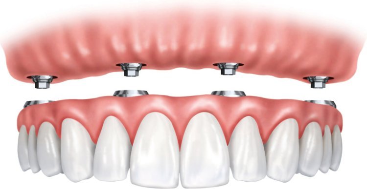 How Long Does Invisalign Treatment Take?