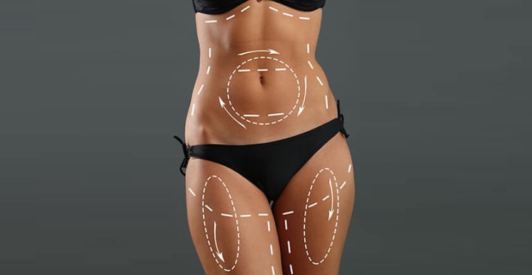 Liposuction for Stubborn Fat: Why Diet and Exercise Aren’t Enough