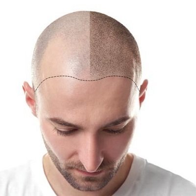 The Future of Hair Transplant Technology