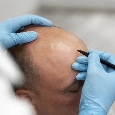 What to Expect After a Hair Transplant: Recovery and Results