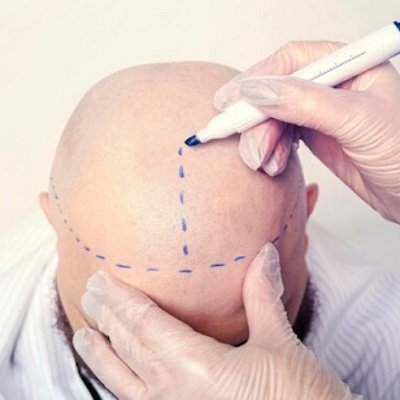 Common Myths About Hair Transplants Debunked