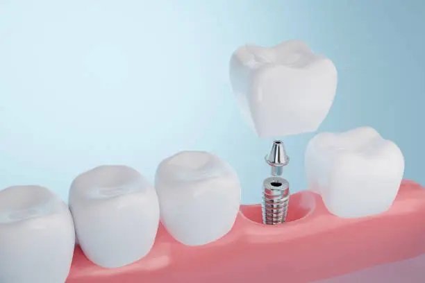 How Brisbane Dentists Handle Broken or Cracked Teeth