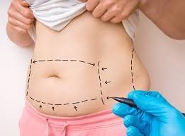 Real Tummy Tuck Results in Dubai – Success Stories