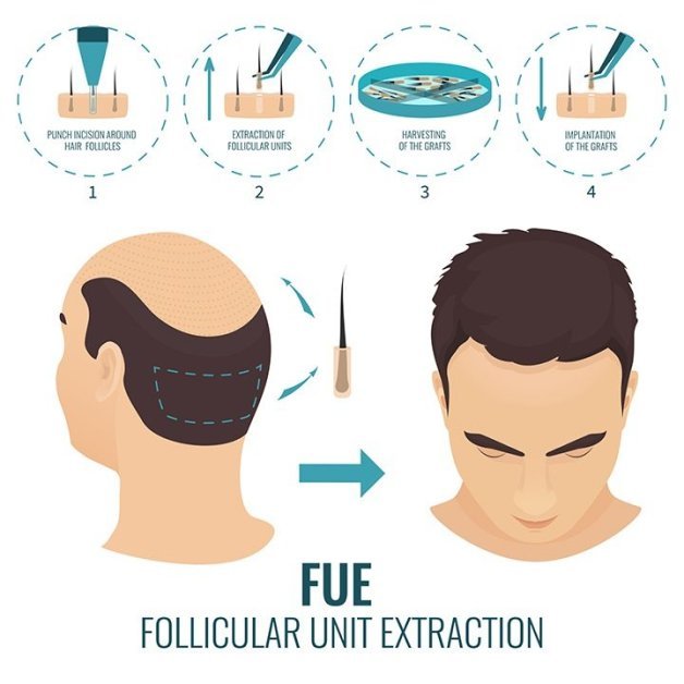 Permanent Hair Restoration with FUE Hair Transplant– Safe & Reliable