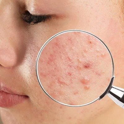 Atrophic Acne Scars: Understanding Treatment Options